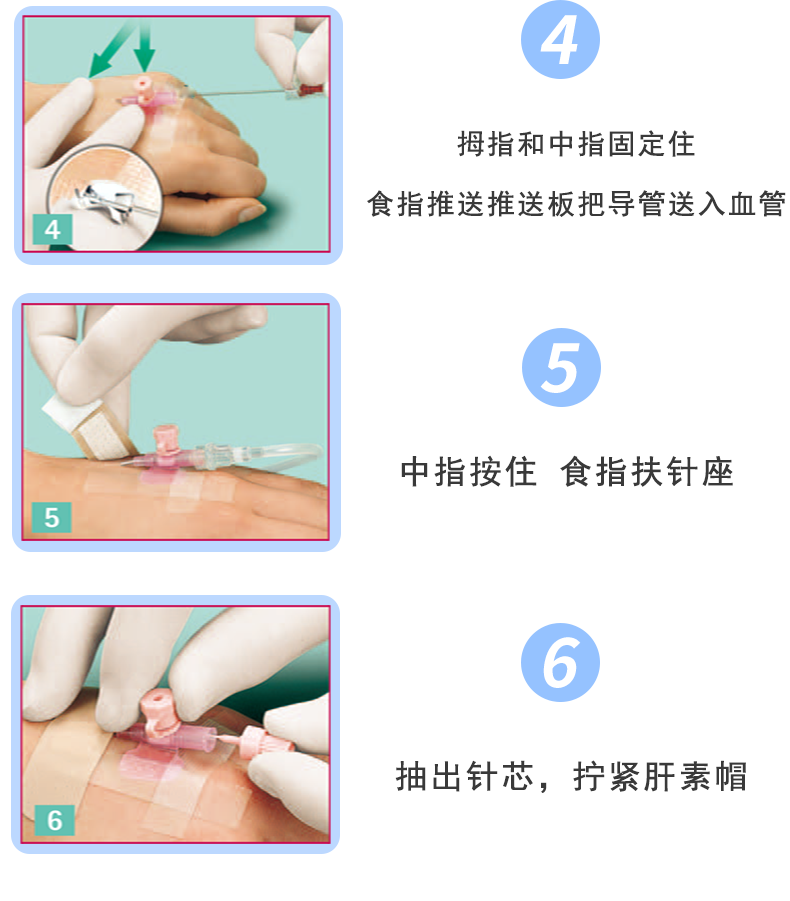 沃素安24G動(dòng)靜脈留置針
